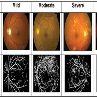 c): Different stages of proliferative diabetic retinopathy ...