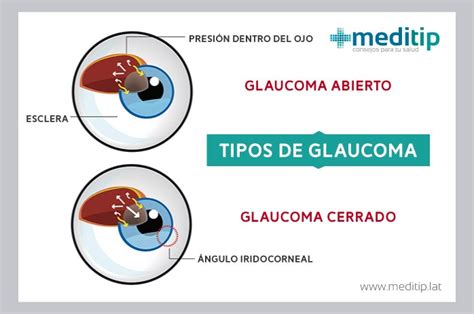 Tratamiento del glaucoma y pruebas de detección de glaucoma Meditip