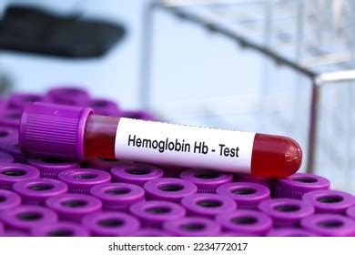 Hemoglobin Hb Test Look Abnormalities Blood Stock Photo 2234772017