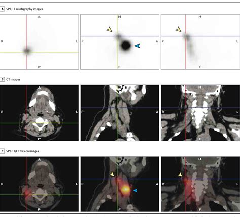 Figure From The Role Of Spect Ct Lymphoscintigraphy And Radioguided