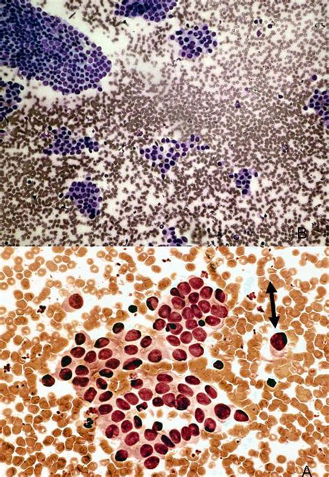 Example Of Indeterminate Thyroid Fine Needle Aspiration Fna Fine