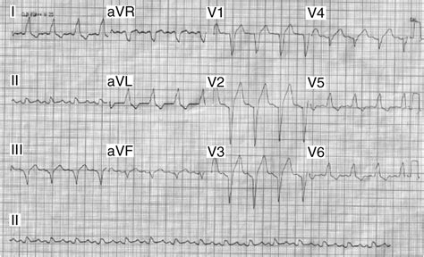 Intermittent Left Bundle Branch Block Lbbb As A Clinical