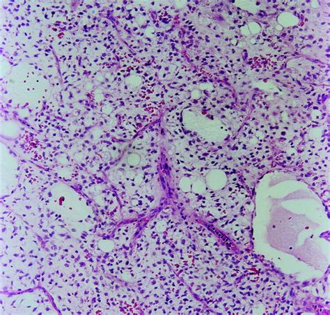 Myxoid Liposarcoma Appearance At Mr Imaging With Histologic