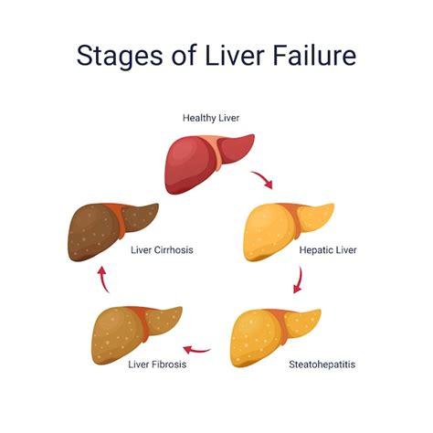 Premium Vector Liver Diseases Stage Anatomy Diagram Vector Illustration