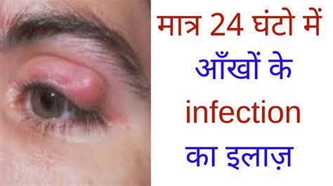 मात्र 24 घंटो में आँखों के Infection का इलाज़ How To Cure Eye Infection Youtube