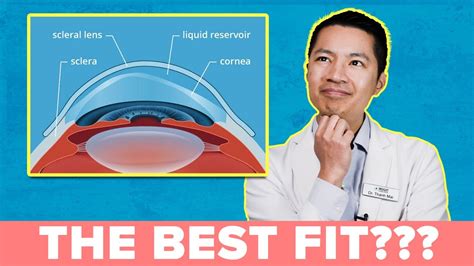 A Must Watch How To Get The Best Scleral Lens Fit Youtube