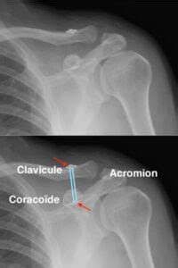 Disjonction acromio-claviculaire - Urgences épaule Paris Ouest