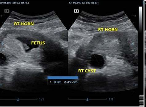 A well-defined anechoic mass in the left ovary consistent with a corpus ...