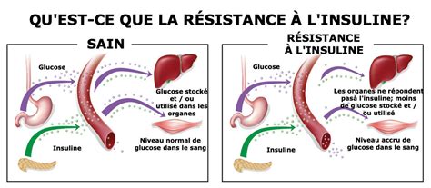 R Sistance L Insuline Causes Sympt Mes Et Pr Vention