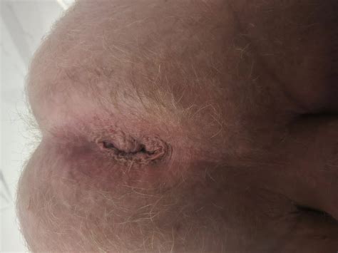 Working On My Gape Nude Pics Xhamster