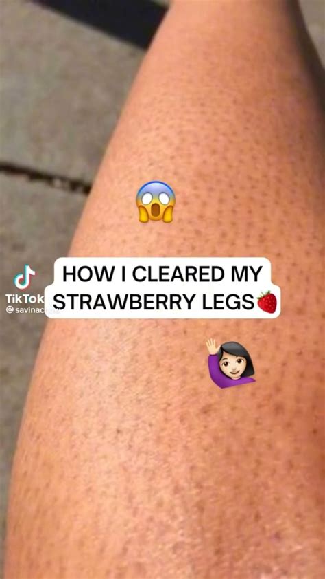 How To Get Rid Of Strawberry Legs In 5 Easy Steps Artofit