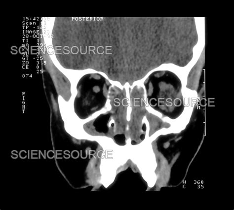 Ct Of Sinuses Stock Image Science Source Images