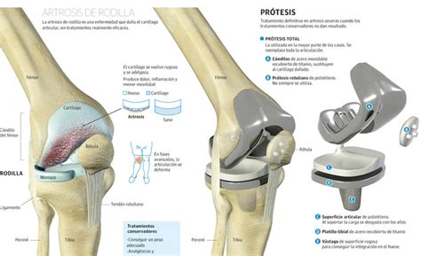 Artroplastia Dra Linette G Mez Traumat Loga Y Ortopedista En