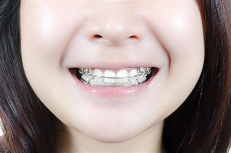 What S The Difference Between Braces And A Plate — North Shore Orthodontics