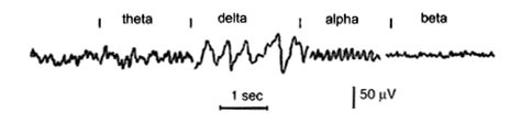 Basic Eeg Waves 四种常见eeg波形 Csdn博客