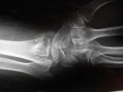 Volar Barton S Fractures Wheeless Textbook Of Orthopaedics