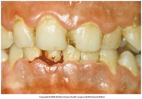 Perio Ch 7 Mucogingival Deformities And Conditions Around Teeth