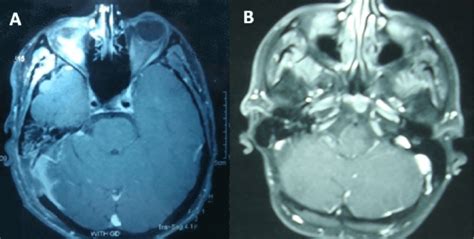 Post Operative Mri Shows Total Resection Of Tumor With No Detectable