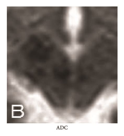 Head MRI on midbrain performed after aggravation of neurological ...