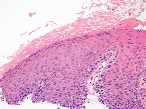 Chapter 10 Histology Of Gastroesophageal Reflux Disease And Barrett’s Oesophagus Abdominal Key