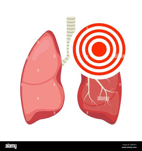 Pneumonia Asthma Lung Pulmonary Vector Inflamed Bronchial Asthma