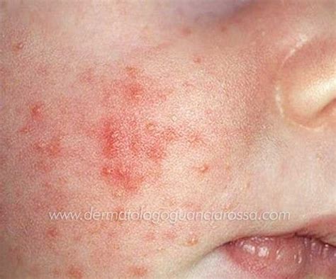 Dermatologia Pediatrica A Sant Ippolito E Fossombrone Dott Ssa