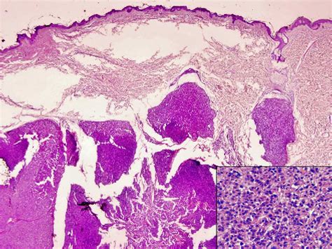 Figure 3 from Cutaneous metastasis from hepatocellular carcinoma after a percutaneous ...