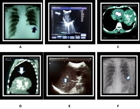 Radiology of Hamartoma. A. X-ray chest (PA view) showing suspicion of ...