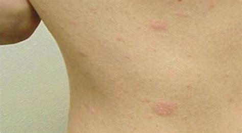 Pityriasis Rosea Kids