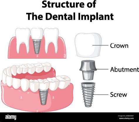 Infographic Of Human In Structure Of The Dental Implant Illustration