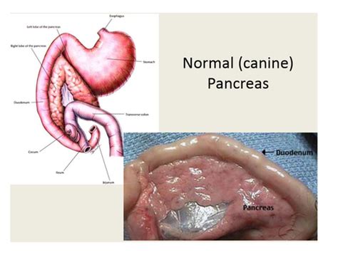 Pathology of the Pancreas Flashcards | Quizlet