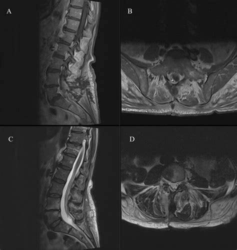 A Postoperative Contrast Enhanced Sagittal T1 Weighted Mri Of The