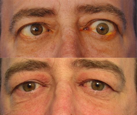 Damaged Eye Socket Reconstruction Surgery Los Angeles | Orbital MD