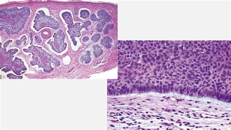 Carcinoma Basocelular Espinocelular Y Su Tratamiento Ppt