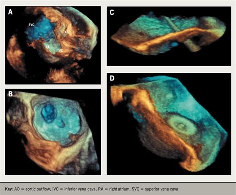 3d Echocardiography Benefits And Steps To Wider Implementation British