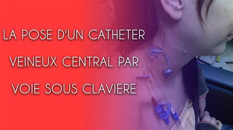 La Pose Dun Catheter Veineux Central Par Voie Sous Claviere Youtube