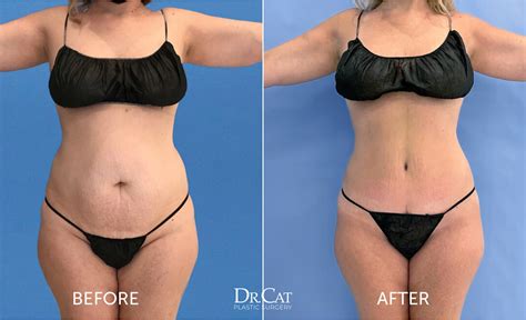 Tummy Tuck Scar Tips And Treatments For Healing Dr Cat