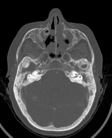 Kartagener’s Syndrome, Primary Ciliary Dyskinesia | Heart