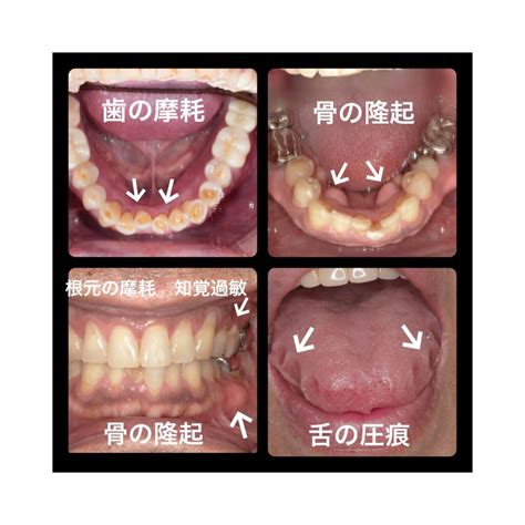 ★歯ぎしり 食いしばり ブラキシズム★｜茅場町・八丁堀の予防歯科・歯医者【nano Dental Care茅場町新川】