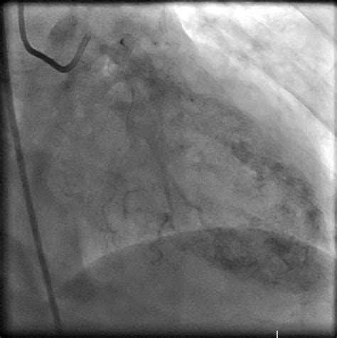 Figure Coronary Cameral Fistula Left Coronary StatPearls