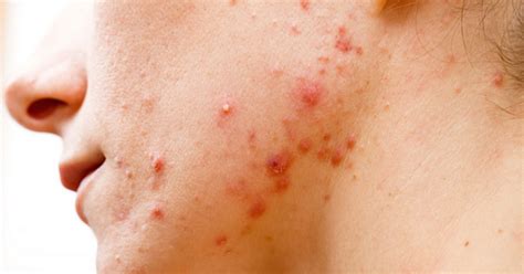 Adult Cystic Acne Symptoms Causes And Treatments ~ Healthy And Strong