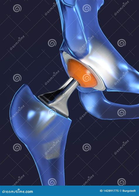 Function Of A Hip Joint Implant Or Hip Prosthesis In Frontal View Stock