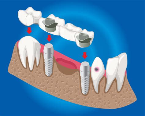 Dental Bridges Endeta Dental Clinic