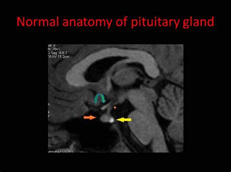 Figure 2 From MRI Imaging Of Sellar And Suprasellar Pathologies A