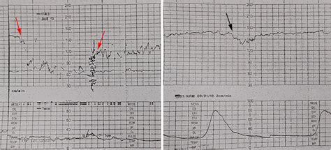 Fetal Heart Rate Monitoring Shows A Spontaneous Prolonged Deceleration Download Scientific