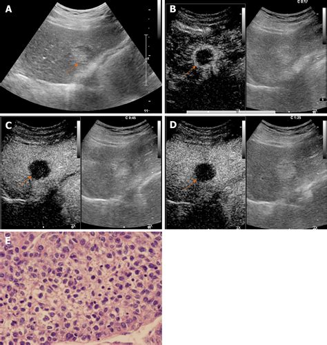 Hepatocellular Carcinoma Ultrasound