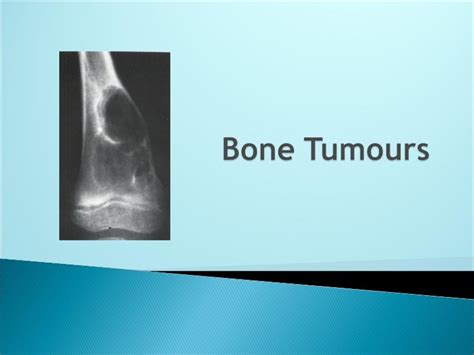 Bone tumours