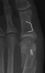 Bunion Surgery – Metatarsal Osteotomy - Cambridge Foot and Ankle Clinic