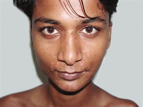 Hypopigmentation Face