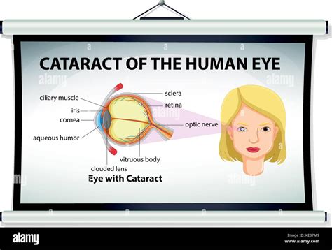 Chart Showing Cataract Of Human Eye Illustration Stock Vector Image And Art Alamy